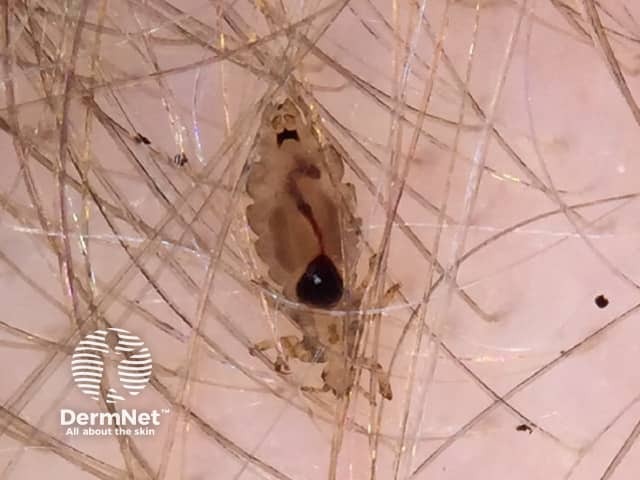 headlouse - Dermnet close-up-image-of-head-louse-from-DermNet
